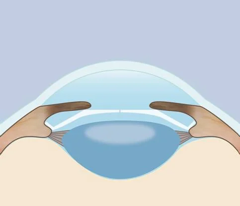 手術後の目の断面図。ICLが茶目（虹彩）と水晶体の間に入っている